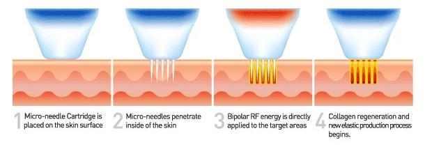 RF Microneedle Fractional Radiofrequency Insulation For Skin Rejuvenation