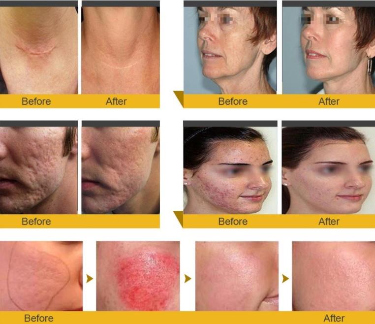 RF Microneedle Fractional Radiofrequency Insulation For Skin Rejuvenation